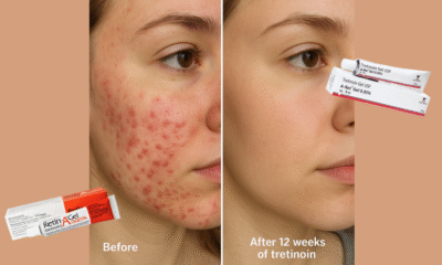 before and after tretinoin 0.05 gel 
