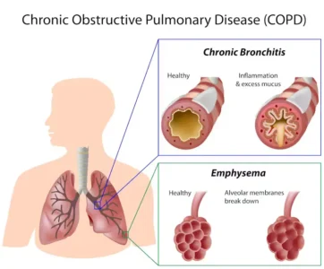 COPD Factors