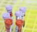 Blood sample tubes representing laboratory monitoring during isotretinoin treatment