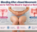 Medical illustration explaining the difference between vaginal and rectal bleeding after a bowel movement